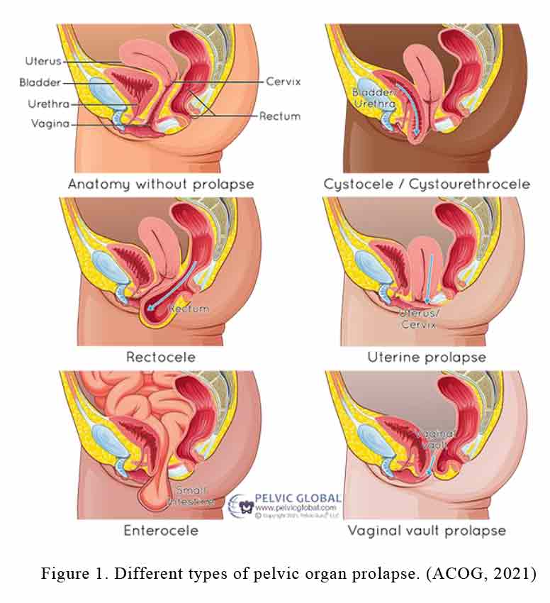 Uterine Prolapse Grading 1024x337 Uterine Prolapse Grading 1024x337